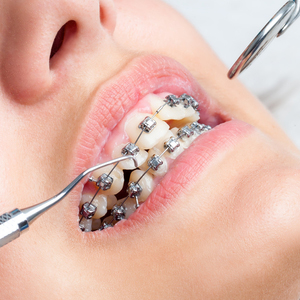 //mmdent.rs/wp-content/uploads/2016/01/orthodontic1.jpg
